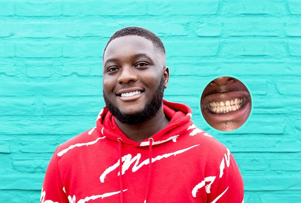 Best Pop On Veneers - Instasmile Best Pop On Veneers - Instasmile