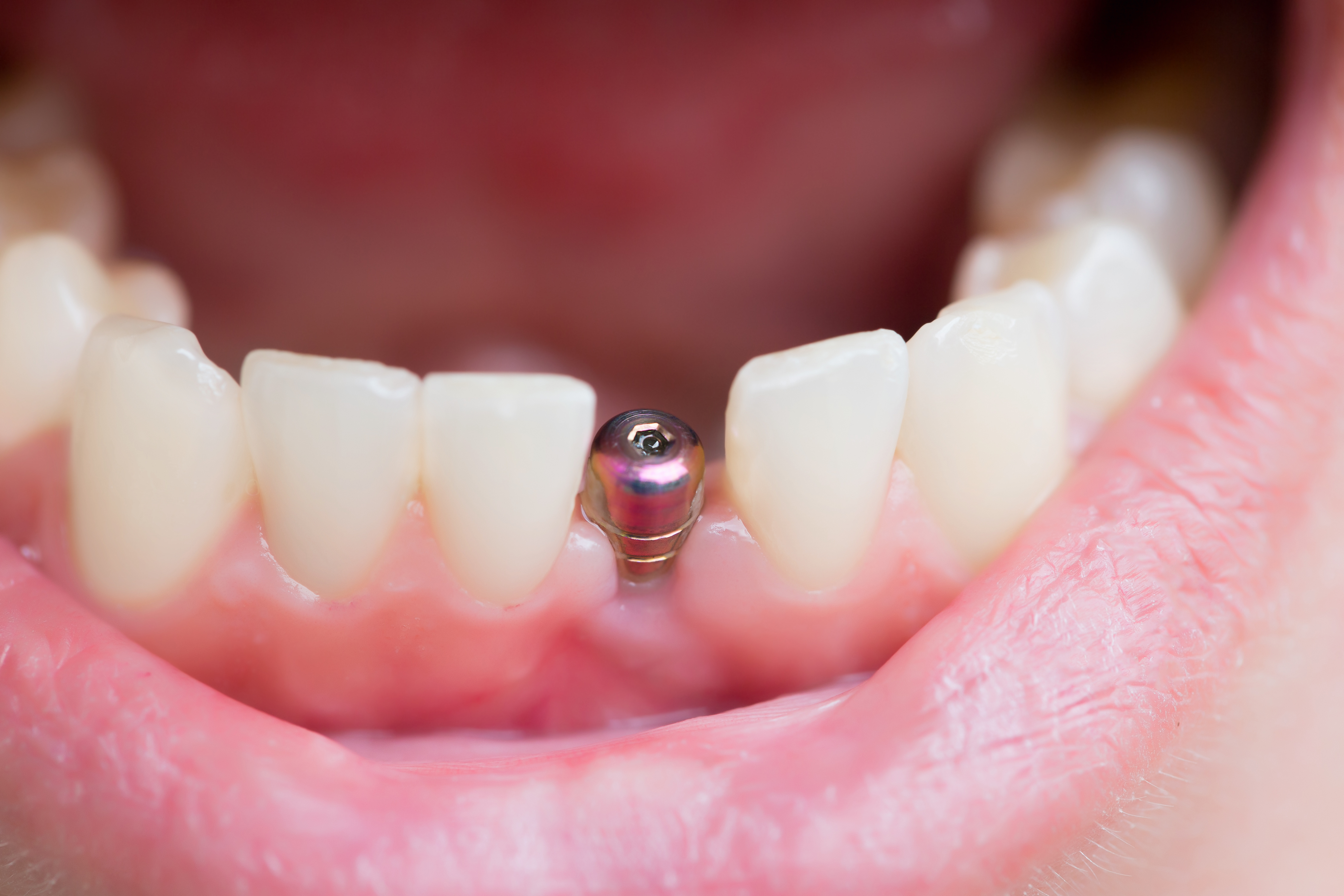 dental implants vs dentures dental implants vs dentures