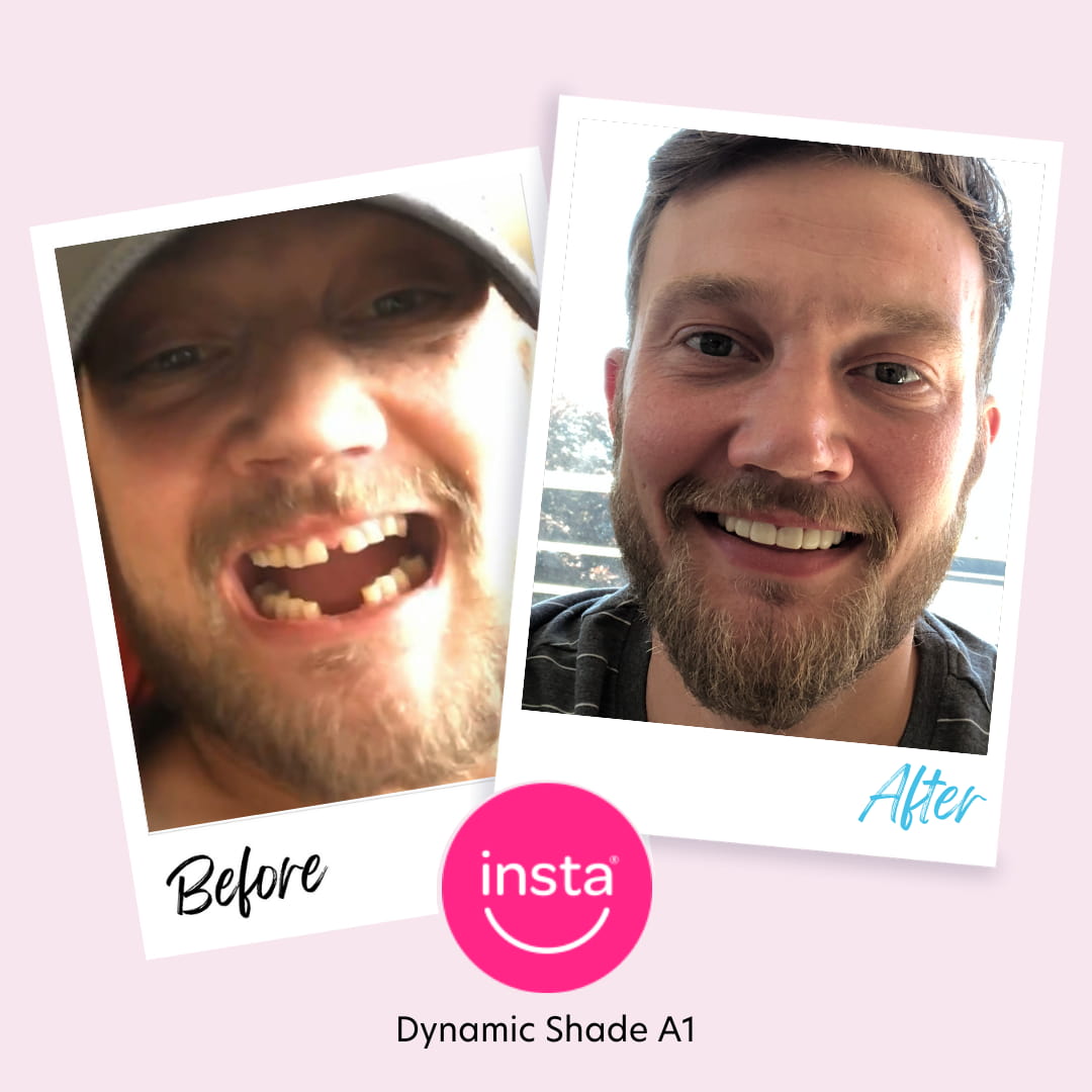 Dentures vs dental implants Dentures vs dental implants