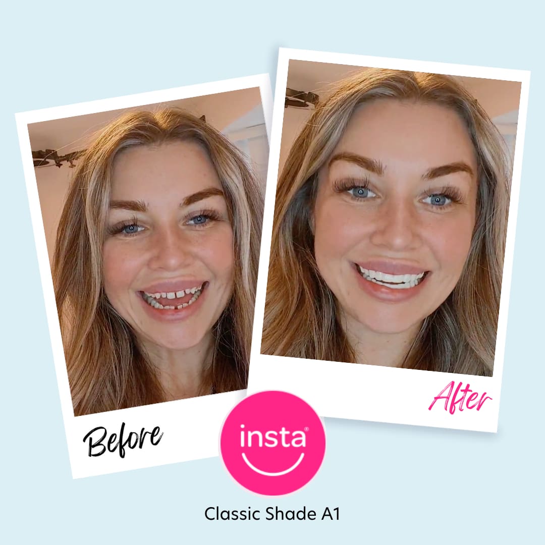 How long do veneers last? - instasmile How long do veneers last? - instasmile