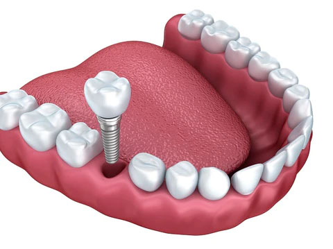 How Long do dental implants last How Long do dental implants last