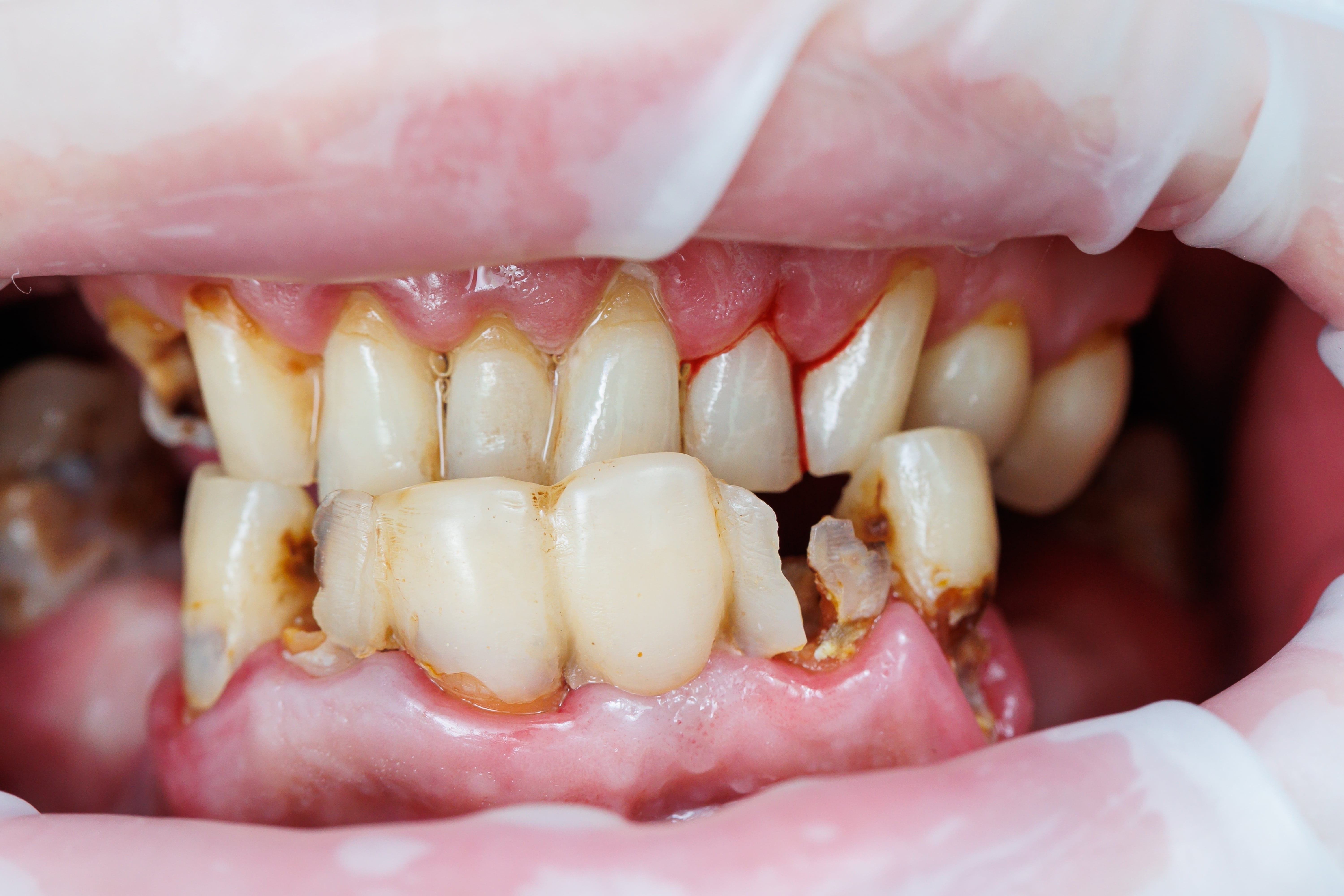 How to hide cavities on front teeth - Instasmile US How to hide cavities on front teeth - Instasmile US