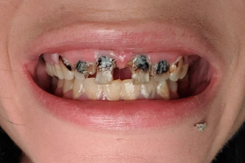 How to hide cavities on front teeth - Instasmile US How to hide cavities on front teeth - Instasmile US