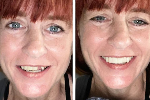 Are pop on veneers safe? - instasmile Are pop on veneers safe? - instasmile
