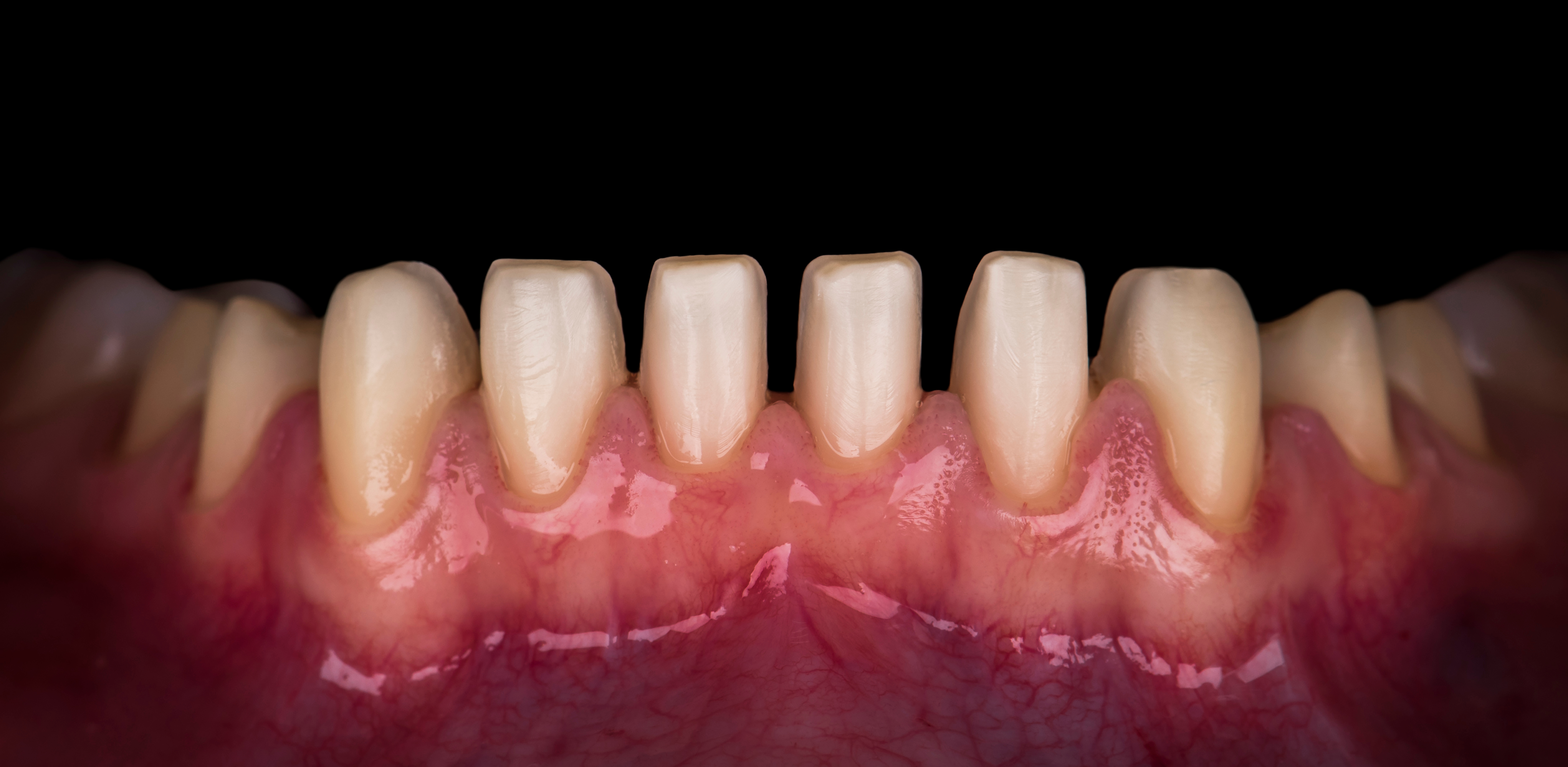 How teeth are affected under veneers - instasmile How teeth are affected under veneers - instasmile