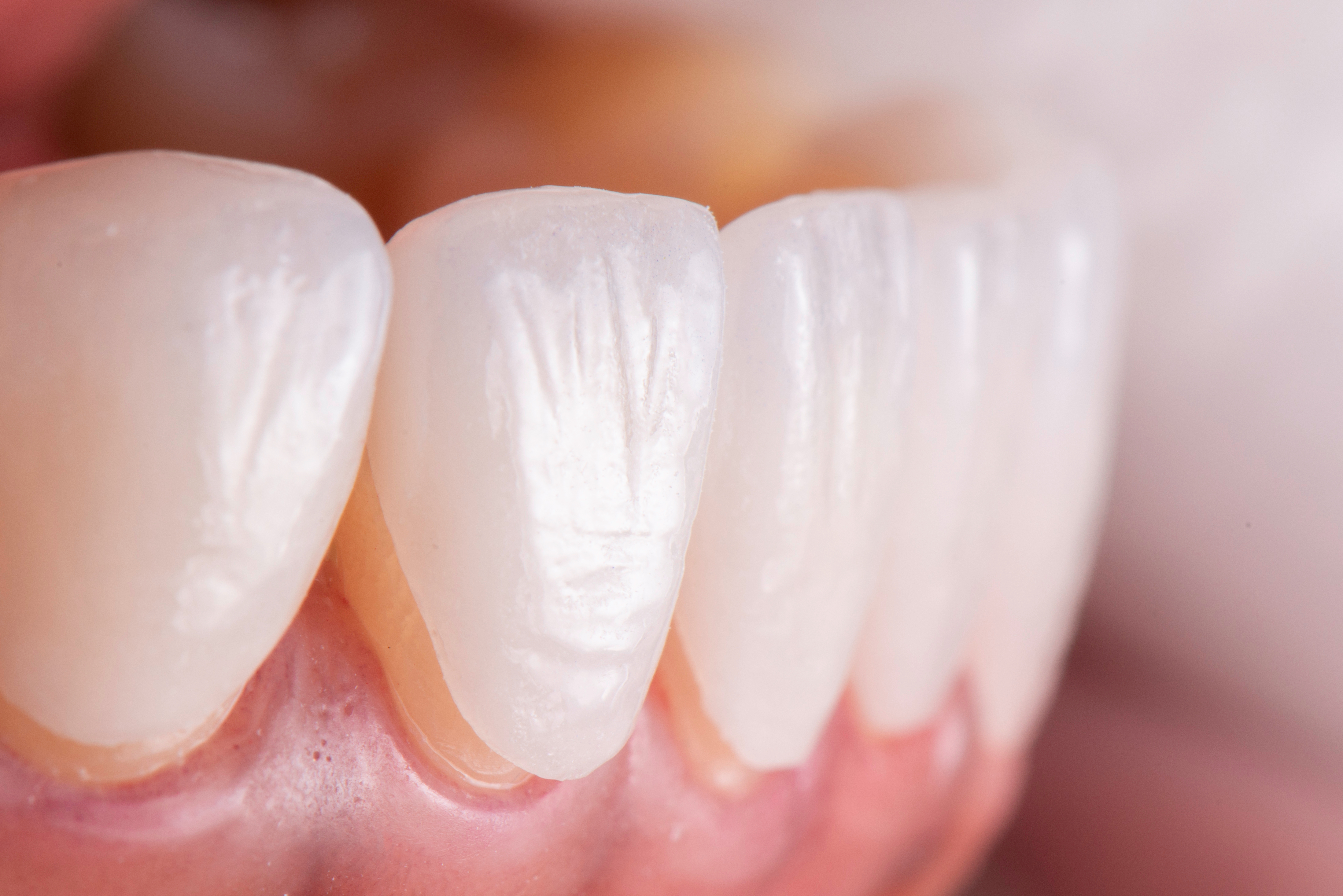 What happens to teeth under veneers - instasmile What happens to teeth under veneers - instasmile