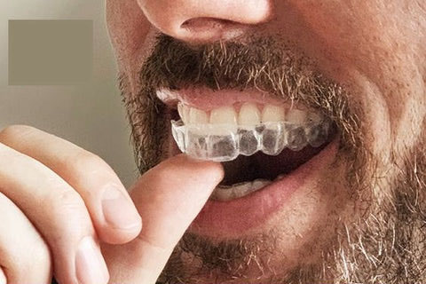 What is Invisalign? What is Invisalign?
